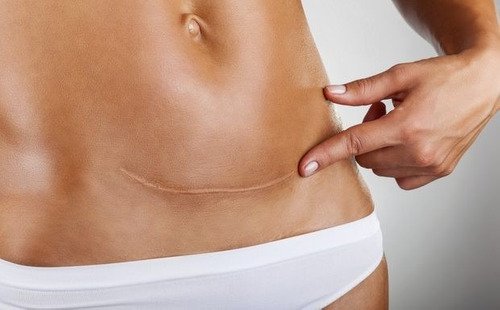 Lamina para cicatrices Rystora - Imagen 2